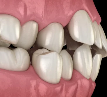 Misaligned Teeth