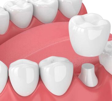 dental crowns