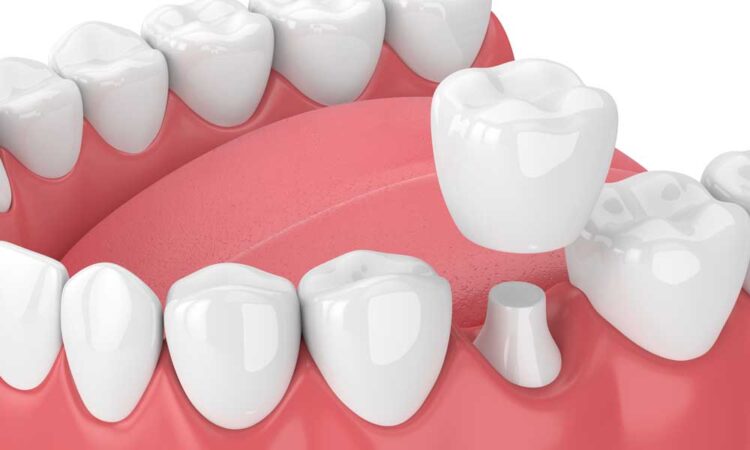 dental crowns