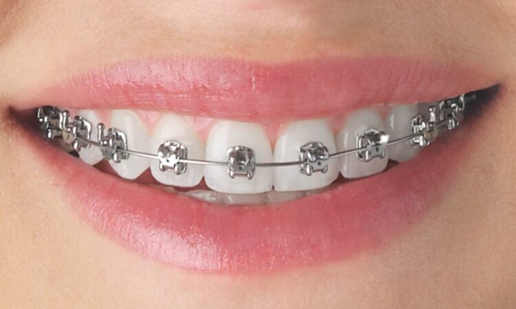 Traditional Braces