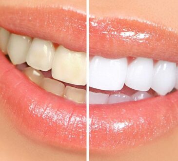 teeth whitening