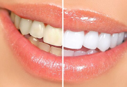 teeth whitening