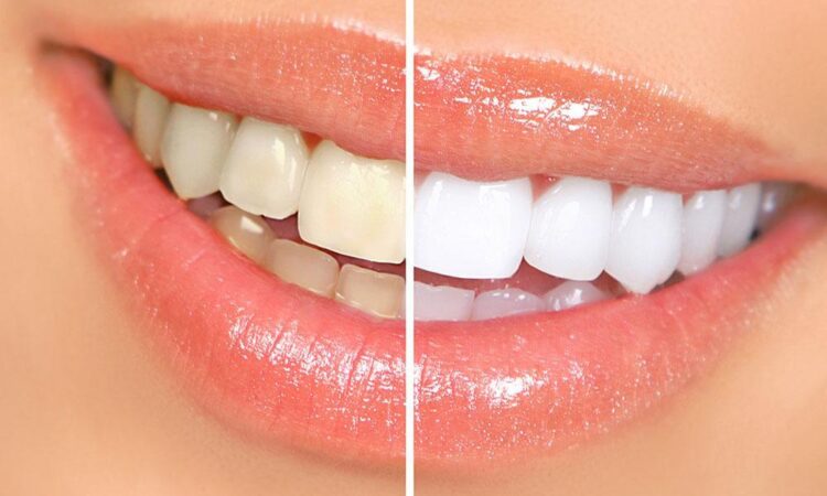 teeth whitening